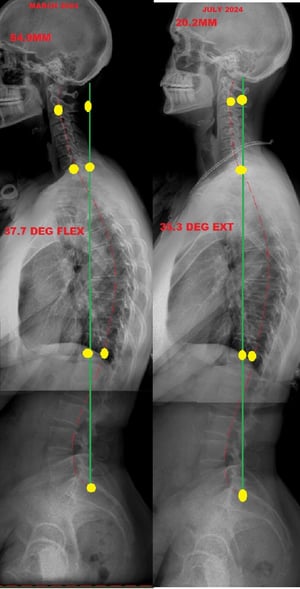 X-ray comparison of a patient's spine from March 2024 to July 2024, showing improvements in spinal alignment, with marked changes in measurements and curvature angles.