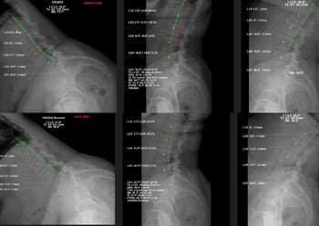 X-ray comparison of the lumbar spine from March 2024 to July 2024, highlighting changes in lumbar vertebrae alignment and curvature, with detailed measurements provided for both dates.