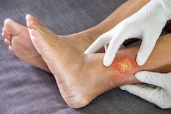 Doctor wearing a white hygienic glove and holding an elderly womans leg to check a wound due to diabetes