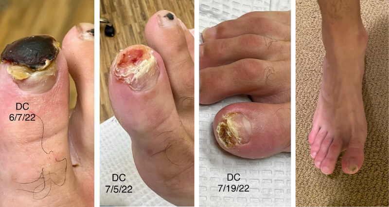 Timeline - Dr. Conenello Uses Extracorporeal Magnetotransduction Therapy to Save Athlete’s Toe and Career